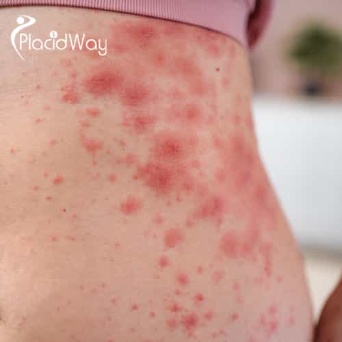 Lupus No More: How Canadians Are Reversing Symptoms with Stem Cells in Guadalajara